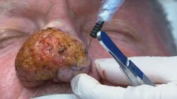 Lessons in Pimple Popping